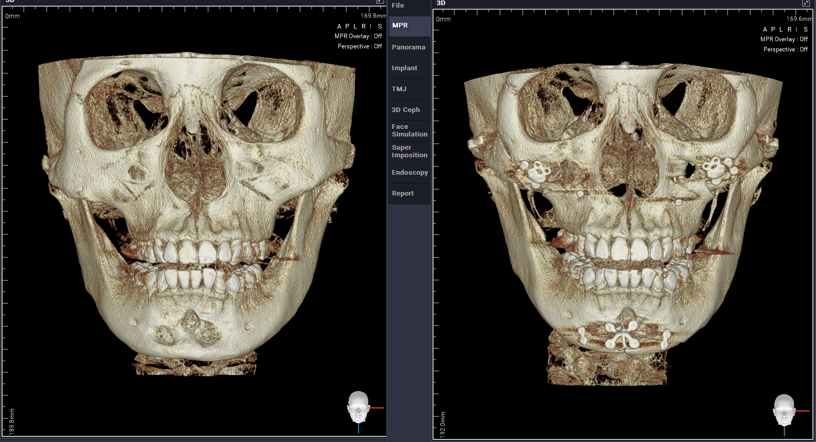 Facial Contouring Revision Surgery – When Is It Necessary? – DL