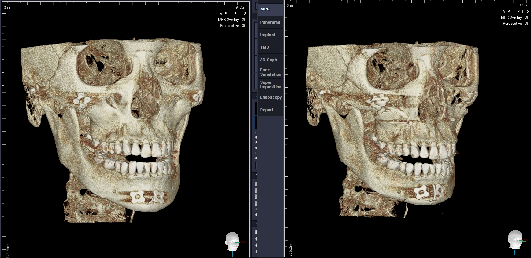 Facial Contouring Revision Surgery – When Is It Necessary? – DL