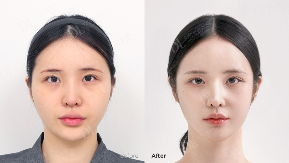 健康・医学 facial bone contouring surgery Current Practices for Esthetic Facial Bone Contouring Surgery in