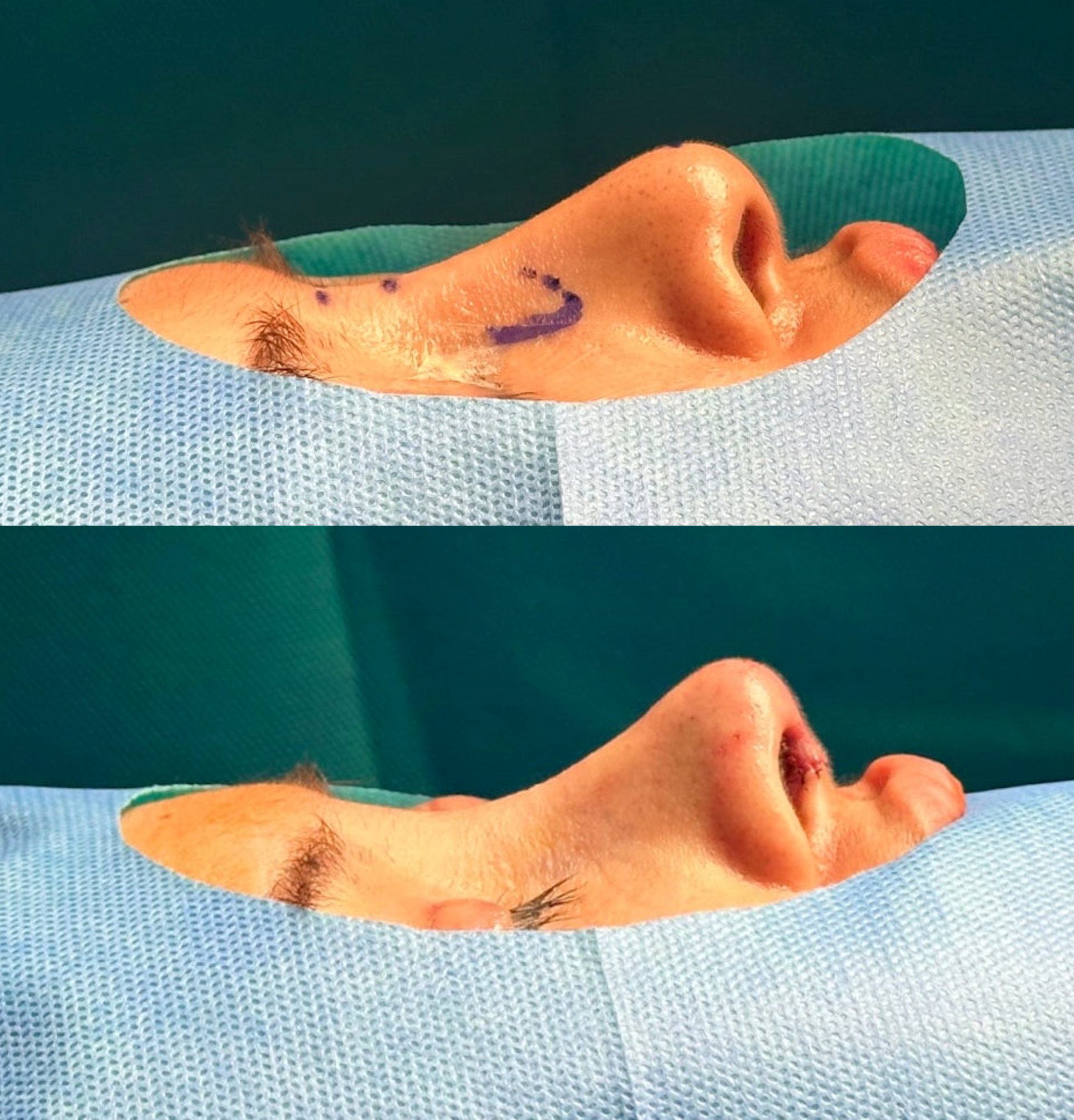 [CASE] Revision Rhinoplasty Using Autologous Rib Cartilage After ...