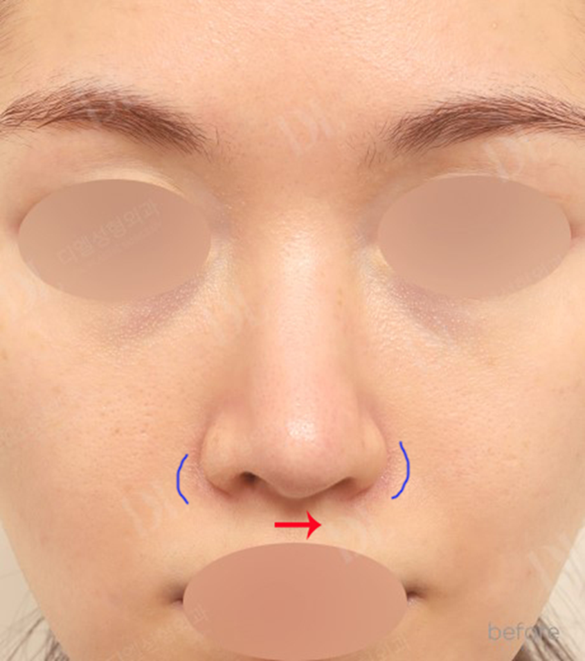 Can Asymmetric Nostrils And A Crooked Nose Be Corrected Together DL can-asymmetric-nostrils-and-a-crooked-nose-be-corrected-together-dl