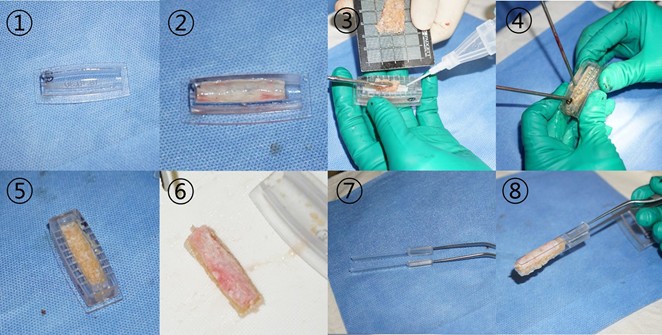 Mini Plastic Rib Autologous Rib Cartilage in Revision Rhinoplasty – DL Plastic Surgery